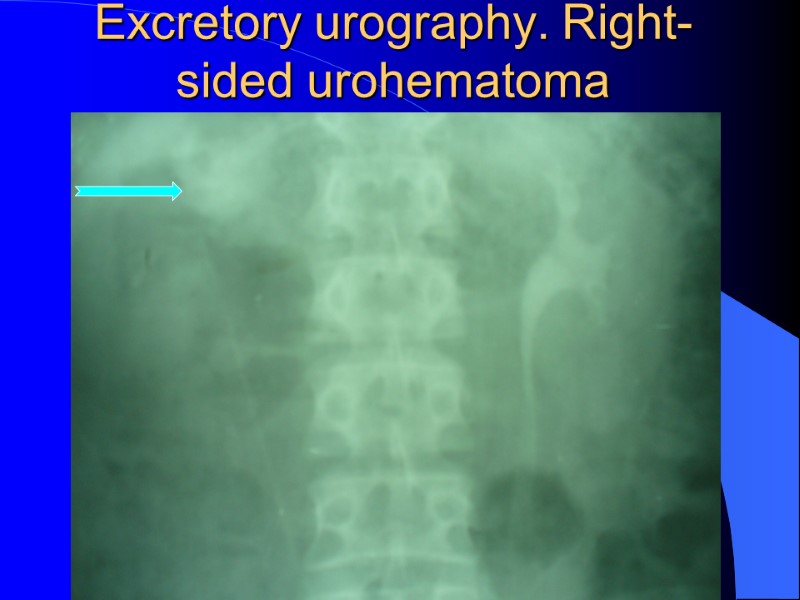 Excretory urography. Right-sided urohematoma Excretory urography. Right-sided urohematoma